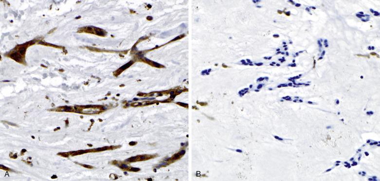 FIG. 2.22, PRKAR1A immunohistochemistry. (A) Retained PRKAR1A expression in myxoma cells. (B) Loss of PRKAR1A expression in myxoma cells from a patient with Carney complex (CNC). Though the loss is not specific for CNC, it is sensitive and should be correlated with molecular genetic studies.