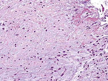 FIG. 2.23, Intimal fibroplasia with myxoid change can mimic a myxoma.