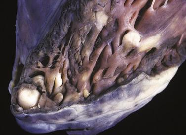 FIG. 2.24, Rhabdomyomas are typically multiple.