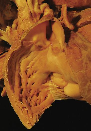 FIG. 2.25, Rhabdomyoma arising in the right atrium extending through the tricuspid orifice into the right ventricular inlet.