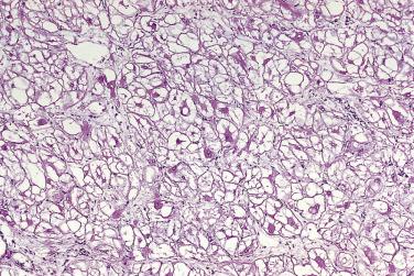 FIG. 2.26, Rhabdomyoma characterized by grotesquely swollen myocytes.