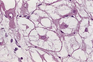 FIG. 2.27, Rhabdomyoma. A high-power view of the specimen in Fig. 2.25 shows the typical “spider cells,” characterized by a centrally placed cytoplasmic mass and nucleus connected to the perimeter of the cell by strands of cytoplasm.