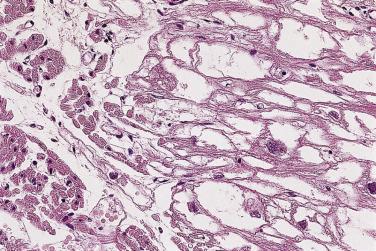 FIG. 2.28, Rhabdomyoma cells compared with adjacent normal myocytes (lower left). The rhabdomyoma cells are very large in comparison.