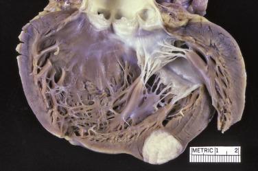 FIG. 2.29, Cardiac fibroma in situ in the left ventricle.