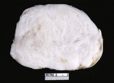 FIG. 2.30, Cardiac fibroma cut surface shows whorled appearance, not unlike that of a leiomyoma.