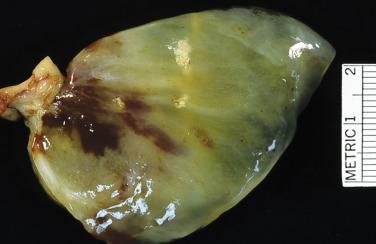 FIG. 2.3, Myxoma with glistening surface and gelatinous consistency.