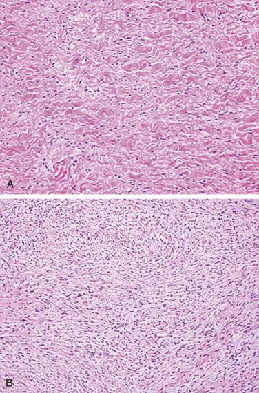 FIG. 2.31, Cardiac fibroma. Typical hyalinized fibroma in an older patient (A), compared with more cellular fibroma (B) in a young child.