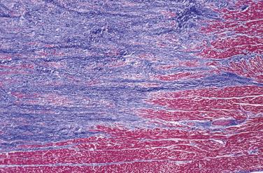 FIG. 2.32, Cardiac fibromas typically intermingle with myocardium at the periphery (trichrome stain).