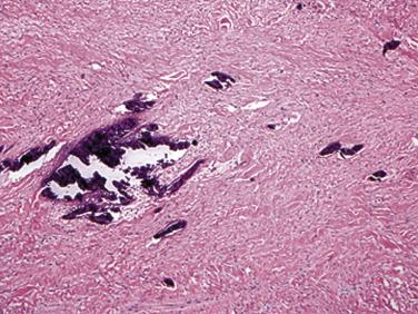 FIG. 2.33, Cardiac fibromas are typically calcified.