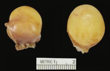 FIG. 2.34, Lipoma arising from the right atrial free wall.