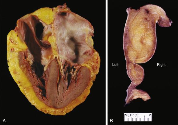 FIG. 2.35, A and B, Lipomatous hypertrophy of the atrial septum. Note the bilobed, dumbbell-shaped morphology.