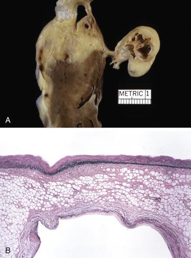 FIG. 2.36, A and B, Lipomatous hamartoma of the tricuspid valve.