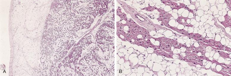 FIG. 2.37, A, Lipoma of the right ventricle. B, Adipose tissue is intermingled with myocytes.