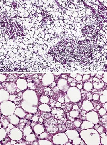 FIG. 2.38, Lipomatous hypertrophy of the atrial septum with marked infiltration of mature fat cells in between remaining myocytes (A). Sometimes, vacuolated, multiglobular fat cells may be prominent and may resemble lipoblasts (B).