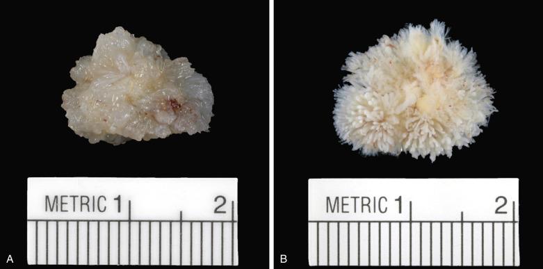 FIG. 2.39, Papillary fibroelastoma. (A) Surgically resected papillary fibroelastoma photographed out of solution to highlight the myxoid gross appearance. (B) When placed in water, the papillary fronds become evident and the tumor takes on its “sea anemone” appearance.