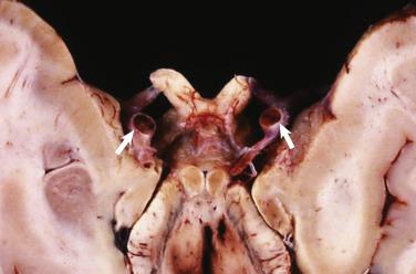 FIG. 2.4, The undersurface of the brain shows bilateral internal carotid artery obstruction (arrows) by myxoma emboli.