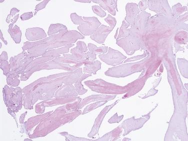 FIG. 2.42, Papillary fibroelastoma showing multiple fronds. The surface lining consists of endothelial cells.