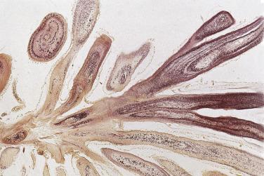 FIG. 2.43, Papillary fibroelastoma on elastic tissue stain highlights the presence of elastic fibers in the central cores.