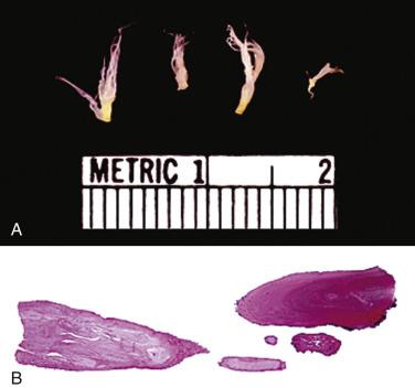 FIG. 2.44, Lambl excrescence gross (A and B). Note the lack of complex papillary architecture characteristic of papillary fibroelastoma.