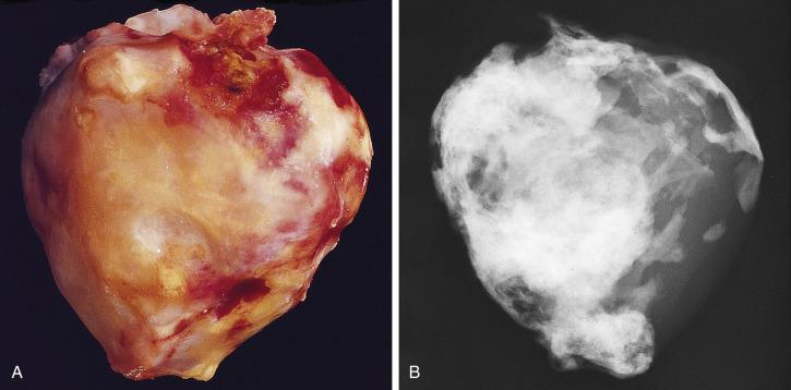 FIG. 2.5, Markedly calcified myxoma, so-called petrified myxoma from the left atrium of a 48-year-old man (A) and its specimen radiograph highlighting heavy calcifications (B).