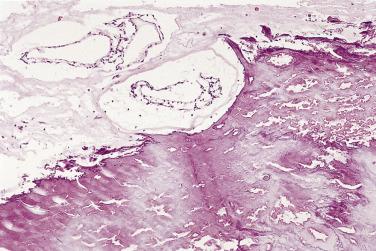 FIG. 2.6, Markedly calcified myxoma. Histology of specimen depicted in Fig. 2.5 shows foci of calcification adjacent to nests of myxoma cells revealing the myxomatous nature of this lesion.