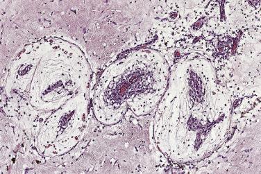 FIG. 2.9, Myxoma cells arranged as a complex interlacing network that often surrounds capillaries.