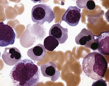 FIG. 22.1, Bone marrow aspirate smear showing prominent dyserythropoiesis in myelodysplastic syndrome. Note marked nuclear irregularities in the late normoblast nuclei. (Wright-Giemsa stain.)