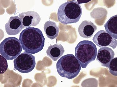 FIG. 22.11, Bone marrow aspirate smear in myelodysplastic syndrome with single lineage dysplasia (refractory anemia) showing erythroid hyperplasia and only subtle nuclear irregularities. (Wright-Giemsa stain.)