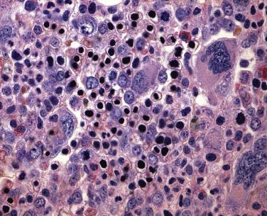 FIG. 22.12, Histologic section of a bone marrow core biopsy specimen in myelodysplastic syndrome with ring sideroblasts (MDS-RS) showing erythroid hyperplasia with nuclear abnormalities apparent in late erythroid progenitors. Iron staining and identification of ring sideroblasts (see Fig. 22.10 ) distinguish this form of MDS with single lineage dysplasia. (Giemsa stain.)