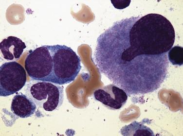 FIG. 22.14, Bone marrow aspirate smear in myelodysplastic syndrome with multilineage dysplasia demonstrating a dysplastic, hypolobated megakaryocyte, a binucleated basophilic erythroblast, and giant neutrophilic band forms. (Wright-Giemsa stain.)