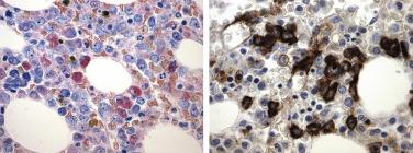 FIG. 22.16, Histologic section of a bone marrow core biopsy in myelodysplastic syndrome with excess blasts–2 (MDS-EB-2) showing increased interstitial blast forms with dispersed chromatin and small distinct nucleoli ( Left panel: Giemsa stain) that are more easily enumerated upon CD34 immunostaining (right panel).