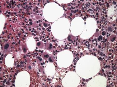 FIG. 22.17, Histologic section of a bone marrow core biopsy in the myelodysplastic syndrome associated with an isolated del(5q). Note the presence of numerous hypolobated megakaryocytes. (Hematoxylin and eosin stain.)