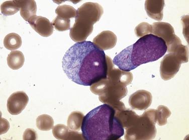 FIG. 22.19, Acute myeloid leukemia. Bone marrow aspirate smear showing myeloblasts with readily discernible Auer rods. (Wright-Giemsa stain.)