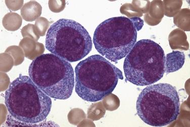 FIG. 22.20, Acute myeloid leukemia. Bone marrow aspirate smear showing monoblasts with round nuclei, prominent nucleoli, and finely granular cytoplasm. (Wright-Giemsa stain.)