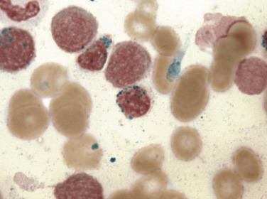 FIG. 22.2, Bone marrow aspirate smear of myelodysplasia showing two ring sideroblasts. (Prussian blue iron stain.)