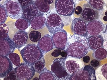 FIG. 22.21, Acute myeloid leukemia. Bone marrow aspirate smear showing erythroid precursors, including proerythroblasts with round nuclei, fine chromatin, and deeply basophilic cytoplasm. (Wright-Giemsa stain.)