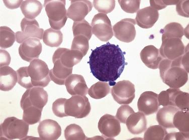 FIG. 22.22, Acute myeloid leukemia. Bone marrow aspirate smear showing a single megakaryoblast with a high nucleus to cytoplasm ratio and small cytoplasmic blebs. (Wright-Giemsa stain.)