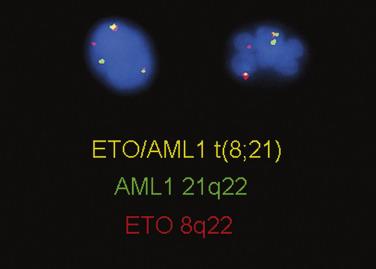 FIG. 22.24, Fluorescence in situ hybridization on interphase nuclei using probes for RUNX1 at chromosome 21q22 (green) and RUNX1T1 at chromosome 8q22 (red) showing the fusion signal (yellow) indicative of the 8;21 balanced chromosomal translocation.