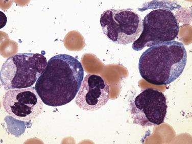 FIG. 22.25, Bone marrow aspirate smear in acute myeloid leukemia with the t(8;21) demonstrating several myeloblasts, including one with a cytoplasmic Auer rod (center, left), and admixed maturing granulocytic forms. (Wright-Giemsa stain.)