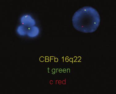 FIG. 22.26, Fluorescence in situ hybridization on interphase nuclei using probes for the centromeric (red) and telomeric (green) regions of CBFB at chromosome 16q22 showing the splitting apart of the red and green signal indicative of either an inv16 or t(16;16) in acute myelomonocytic leukemia with eosinophilia.