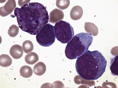 FIG. 22.28, Bone marrow aspirate smear from a case of acute myelomonocytic leukemia with eosinophilia and the inv(16) showing a mixture of myeloblasts and monoblasts (lower right) and an abnormal eosinophilic form with prominent large basophilic granules ( upper left ; so-called eo-baso). (Wright-Giemsa stain.)