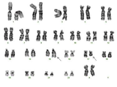 FIG. 22.29, Karyotypic analysis demonstrating the 15;17 balanced chromosomal translocation of acute promyelocytic leukemia.