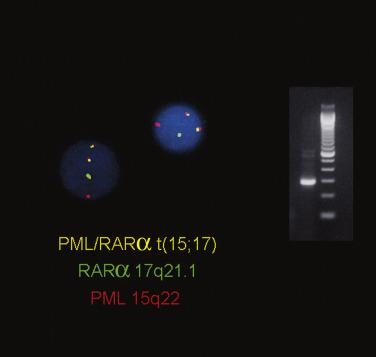 FIG. 22.30, (Left) Fluorescence in situ hybridization on interphase nuclei using probes for RAR α at chromosome 17 (green) and PML at chromosome 15q22 (red) showing the fusion signal (yellow) indicative of the 15;17 balanced chromosomal translocation. (Right) Agarose gel demonstrating the presence of the PML-RAR α fusion transcript ( left lane: 1-kb ladder in right lane ) in a case of acute promyelocytic leukemia with the t(15;17), as detected by a reverse transcriptase polymerase chain reaction (RT-PCR) technique.