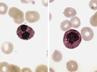FIG. 22.3, Myelodysplastic syndrome. Peripheral blood film showing dysplasia in mature neutrophilic granulocytes. Pseudo–Pelger-Huet form (left) and nonsegmented neutrophil (right). (Wright-Giemsa stain.)