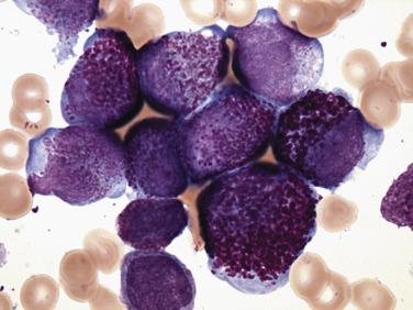 FIG. 22.32, Bone marrow aspirate smear from a case of hypergranular acute promyelocytic leukemia with the t(15;17), showing large atypical promyelocytes with eccentric nuclei and numerous darkly staining granules that fill the cytoplasm and overlie the nucleus. (Wright-Giemsa stain.)