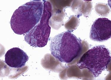 FIG. 22.33, Bone marrow aspirate smear in hypergranular acute promyelocytic leukemia with the t(15;17) showing promyelocytes with numerous Auer rods that resemble bundles of sticks (so-called faggot cells). (Wright-Giemsa stain.)