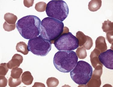 FIG. 22.34, Bone marrow aspirate smear from a case of microgranular acute promyelocytic leukemia with the t(15;17) showing atypical promyelocytes with folded or bilobed nuclei and indistinct to undetectable cytoplasmic granules. (Wright-Giemsa stain.)