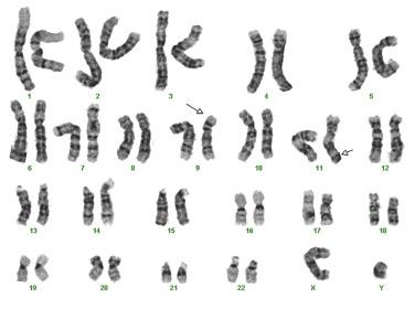 FIG. 22.36, Karyotypic analysis demonstrating a 9;11 balanced chromosomal translocation indicative of a KMT2A (MLL) gene rearrangement in acute myeloid leukemia.