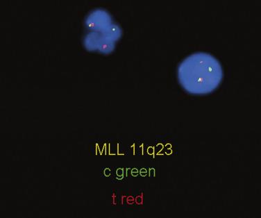 FIG. 22.37, Fluorescence in situ hybridization on interphase nuclei using probes for the centromeric (red) and telomeric (green) regions of KMT2A (MLL) gene at chromosome 11q23, showing the splitting apart of the red and green signal indicative of a leukemia involving a rearrangement of the KMT2A gene.