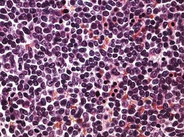 FIG. 22.38, Histologic section of a bone marrow core biopsy from a case of acute myeloid leukemia, minimally differentiated, demonstrating small blast forms with variably distinct nucleoli and scant cytoplasm. This histologic appearance is nearly identical to that of acute lymphoblastic leukemia (see Fig. 22.56 , later), with accurate diagnosis as acute myeloid leukemia requiring immunophenotypic studies. (Hematoxylin and eosin stain.)